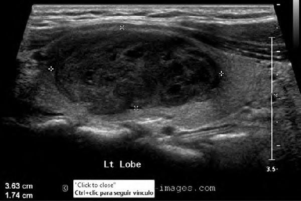 Figura 1. Ultrasonografía de un paciente con carcinoma papilar en el lóbulo izquierdo