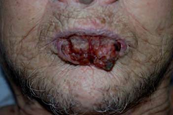 Figura 2. Paciente con carcinoma escamocelular agresivo del labio inferior. La evaluación no demostró compromiso metastásico ganglionar o sistémico
