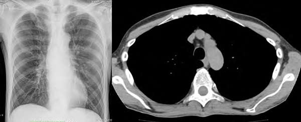 Figura 7. Radiografía y escanografía de tórax en donde no se observa derrame pleural.