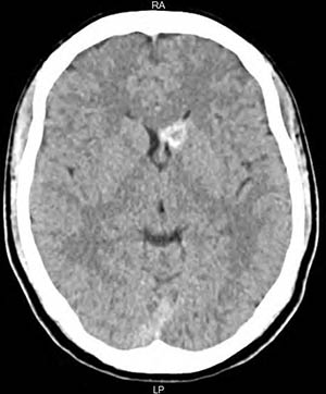 Figura 3. Colección en el asta frontal del ventrículo lateral izquierdo y núcleo caudado estable sin evidencia de resangrado.