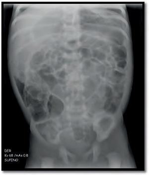Figura 1. Radiografía simple anteroposterior de abdomen. Se observa distensión de asas y escasos niveles hidroaéreos sugestivos de íleo y sospecha de ECN.