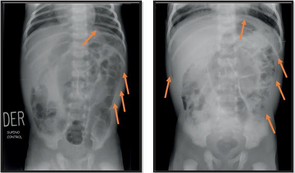 Figuras 2 y 3. Radiografías simples anteroposteriores de abdomen. Evidencia de neumoperitoneo
