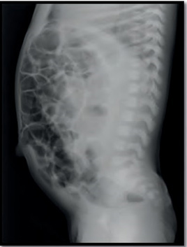 Figura 4. Radiografía simple lateral de abdomen. Se observa distención de asas y escasos niveles hidroaéreos sugestivos de íleo.