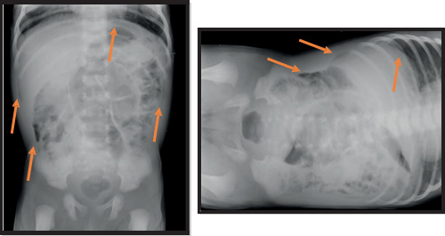 Figuras 5 y 6. Radiografías simples de abdomen en proyección anteroposterior y decúbito lateral.
