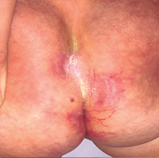Figura 4. Úlceras resueltas, presencia  de cutis marmorata telangiectásica.