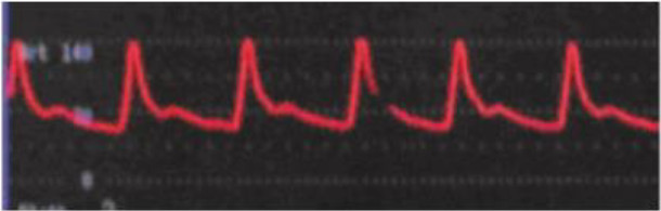 Figura 1. Representación de una onda de pulso mediante un transductor de presión intra-arterial.