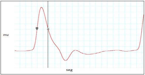 Figura 5. Representación metodológica del análisis de la onda de pulso.