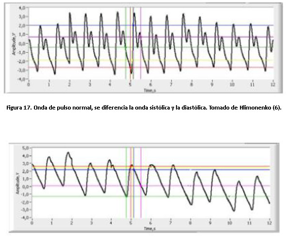 Figura 17. Onda de pulso normal, se diferencia la onda sistólica y la diastólica. Tomado de Hlimonenko (6).