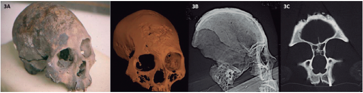 Figura 3. Cráneo de Aguazuque. Presenta en la fotografía inicial unas lesiones de caries sicca en región frontoparietal derecha (A), que se nota en la fotografía de la reconstrucción digital (B). En las fotografías de las