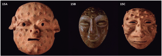 Figura 15. Bartonelosis. Las dos primeras máscaras (15A y 15B) pertenecen a la cultura ecuatoriana prehispánica