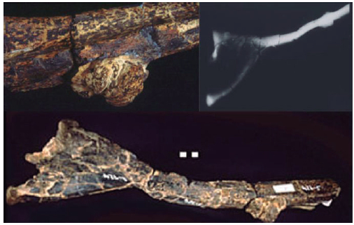 Figura 4. Fragmento de la costilla derecha de un gran dinosaurio, Apatosaurus sp., que presenta una masa subredondeada