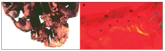 Figura 7A. Cambios osteolíticos en el paladar duro por un carcinoma primario de nasofaringe en un hombre de