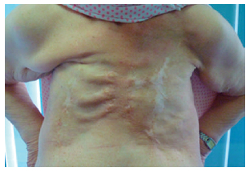 Figura 1. Paciente con mastectomia suprarradical