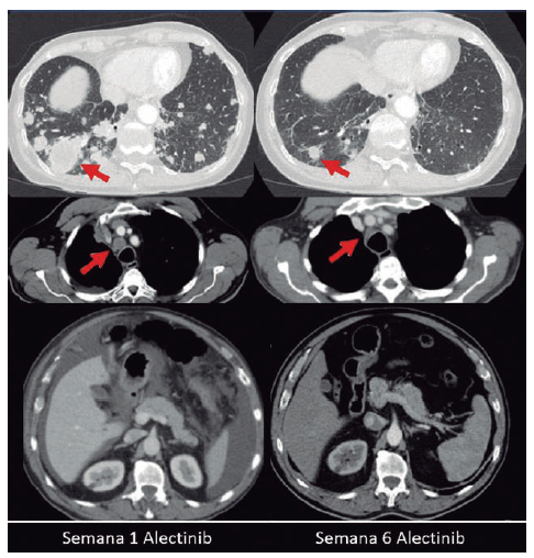 Figura 10. Paciente con adenocarcinoma de pulmón ALK positivo con extenso compromiso tumoral ganglionar