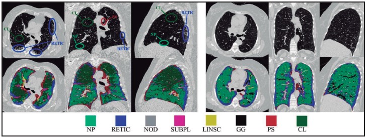 Figura 3. Resultados de la clasificación automática en dos tomografías con diferentes subtipos de anormalidad