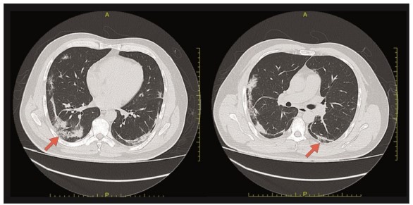 Figure 1. High-resolution chest computed tomography