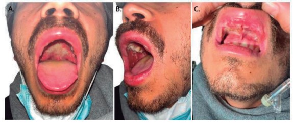 Figure 1. Upon hospital admission (Fourth day of oral lesions).