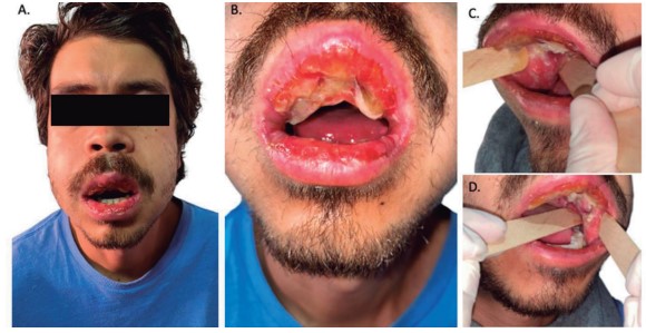 Figure 2. Twelve hours of hospital admission (Fifth day of oral lesions). Increased edema in the lower two thirds of