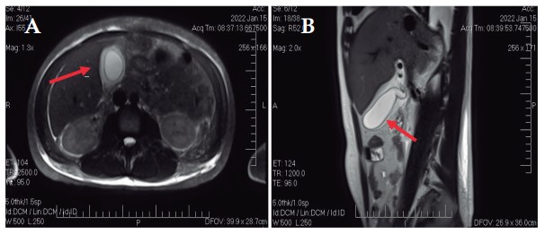 Figure 1. Magnetic Resonance Cholangiography.
