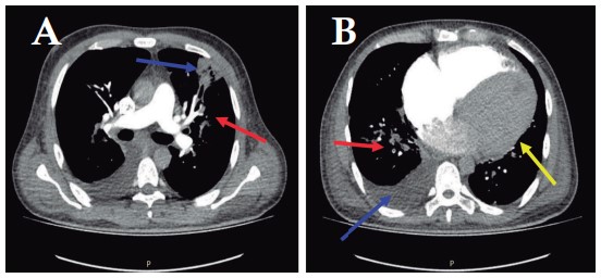 Figure 2. Computed angiotomography of the chest with contrast, axial view