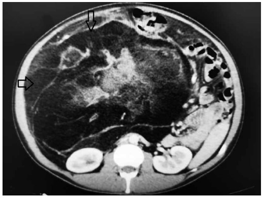 Figura 1. Tomografía axial computarizada que muestra la tumoración.