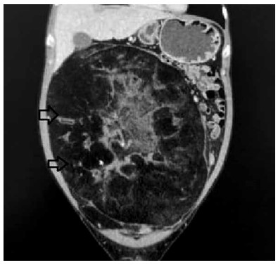 Figura 2. Liposarcoma en su interior necrosis con asas