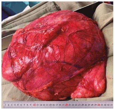 Figura 3. Vista del tumor después de la resección (más