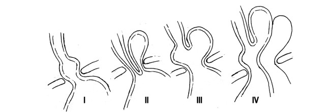 Figura 2. Tipos de hernia hiatal. 1. HH por deslizamiento, 2. HH paraesofágica, 3. Mixta, 4.