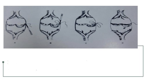 . Representación de valvuloplastia intraluminal de Kirstner.