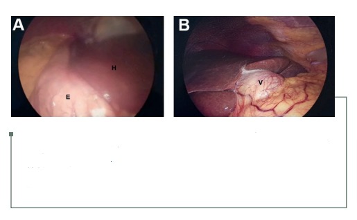 A. Vista laparoscópica hipocondrio derecho e izquierdo